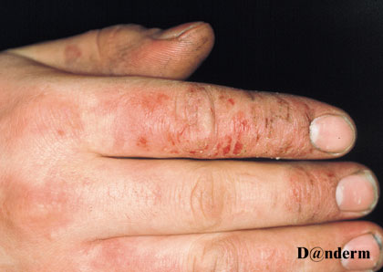 disidrosiko-eczema-1