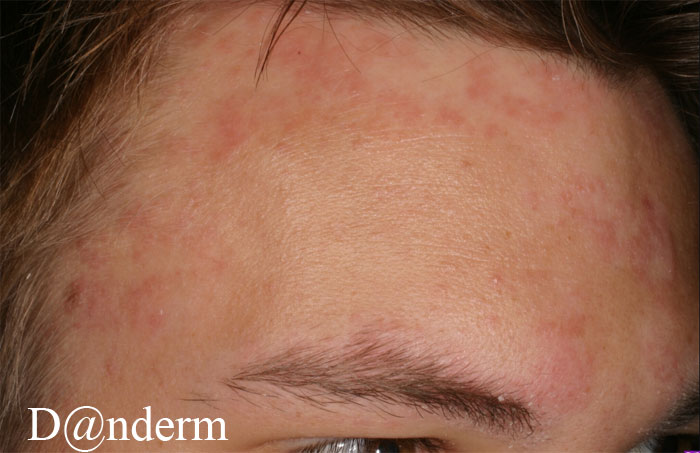 smigmatoroiki-dermatitida