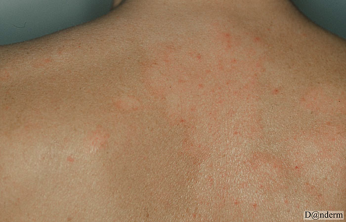 smigmatoroiki-dermatitida2